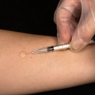 Tuberculin skin test